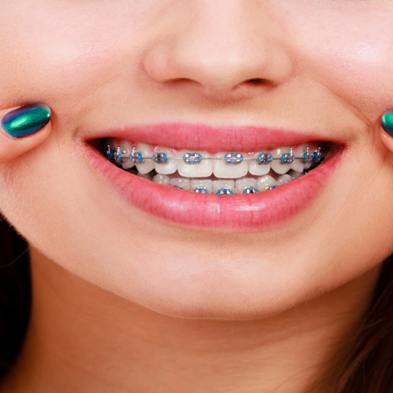 Dental-Braces-one